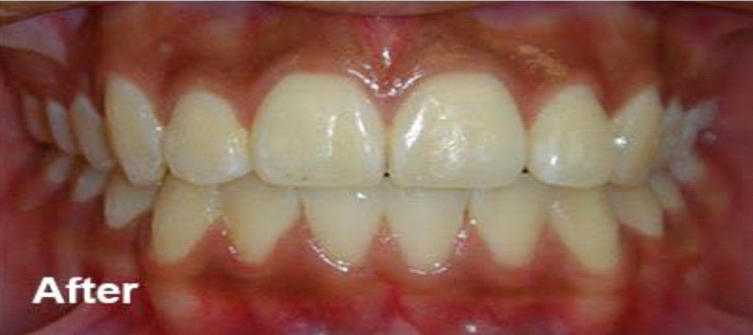 after braces after braces