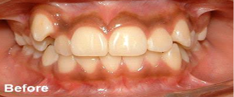 before braces before braces