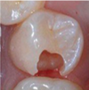 child-teeth-cavities-before child-teeth-cavities-before