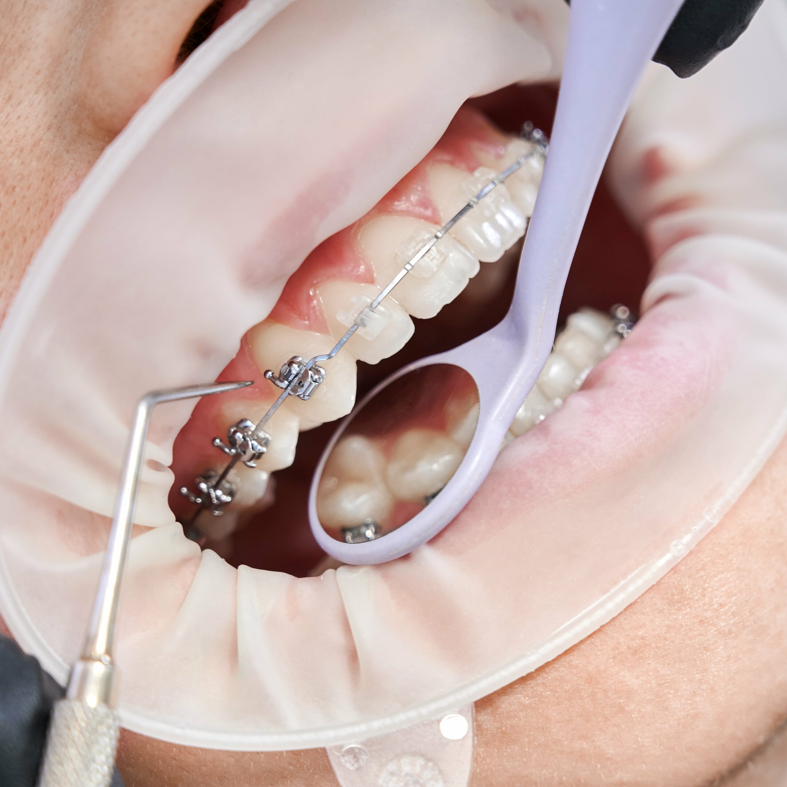 dentist-attaching-metal-braces-patient-teeth-min (1) dentist-attaching-metal-braces-patient-teeth-min (1)