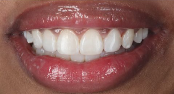 gum contouring after gum contouring after