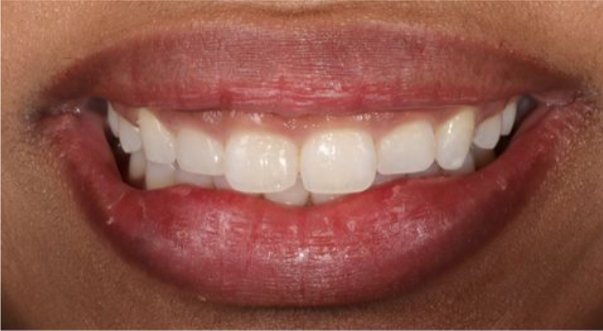 gum contouring before gum contouring before