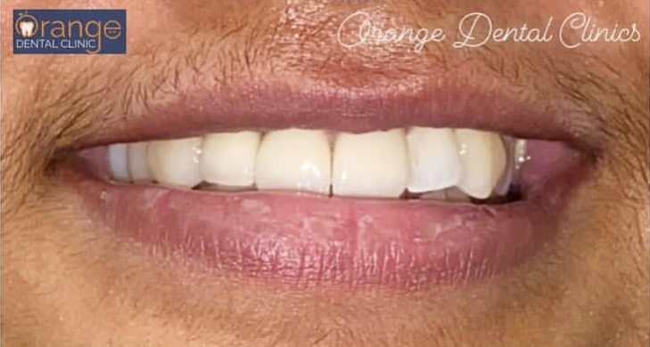 dental crown after 1 dental crown after 1