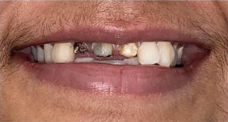 dental crown before 1 dental crown before 1