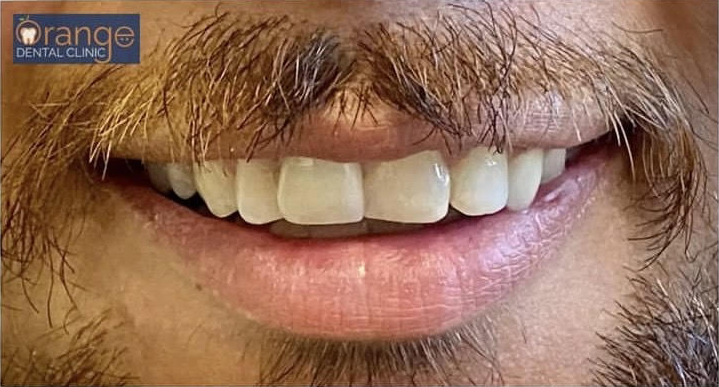 dental filling after 1 dental filling after 1