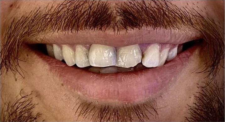 dental filling before 1 dental filling before 1