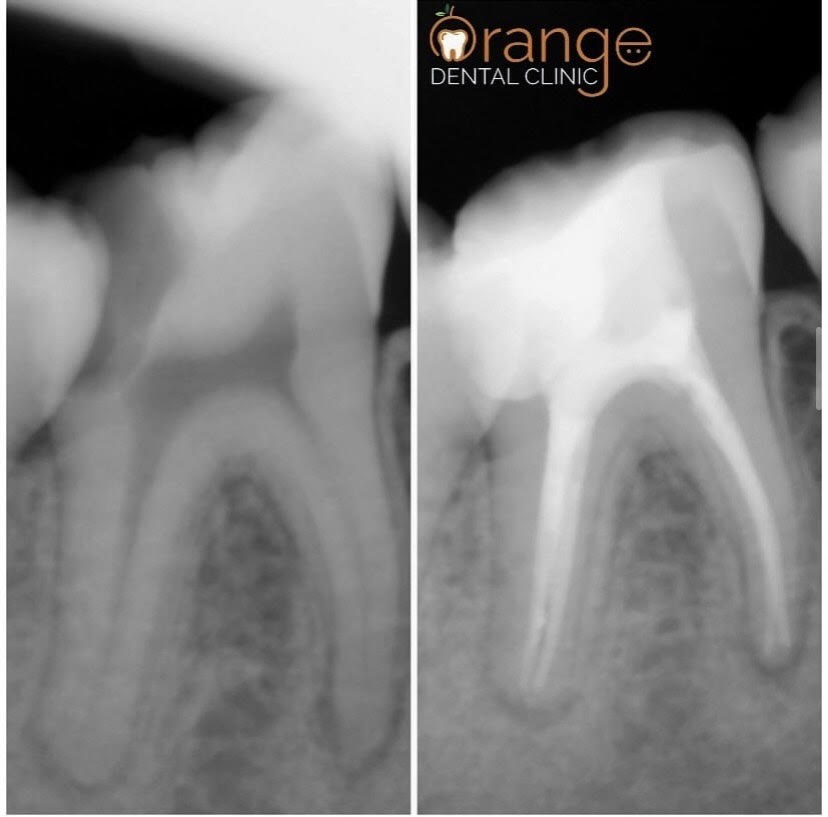 root canal 1 root canal 1