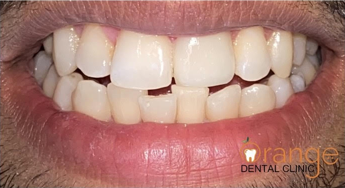 teeth whitening after 1 teeth whitening after 1