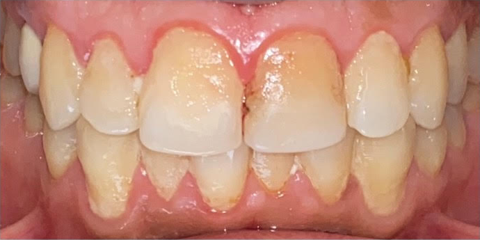 teeth whitening before 1 teeth whitening before 1
