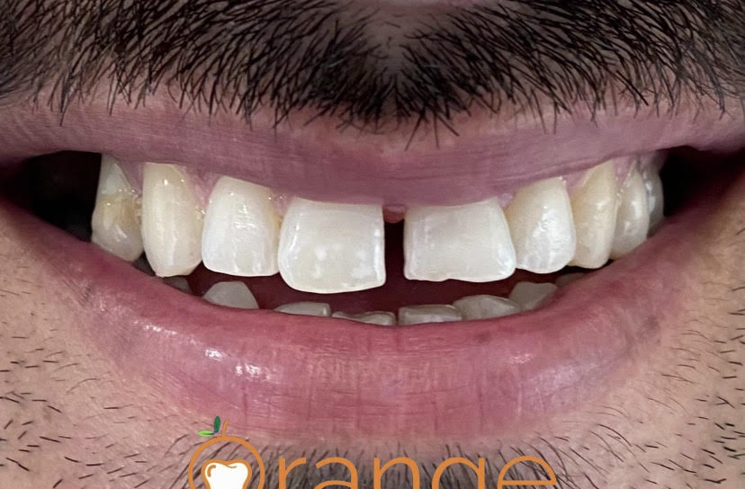 veneer before1 veneer before1